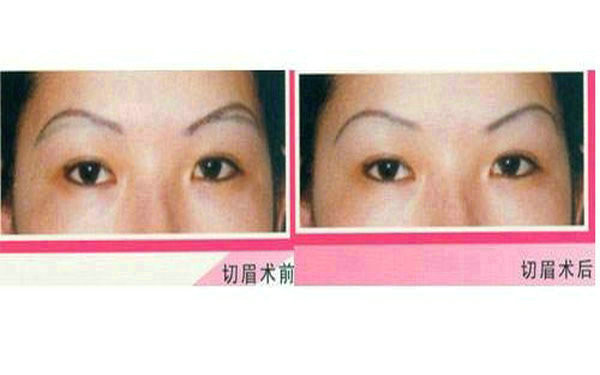 太原比較好的解決雙眼皮問(wèn)題的口碑醫(yī)生，看圖評(píng)價(jià)弓軍勝的修復(fù)案例！
