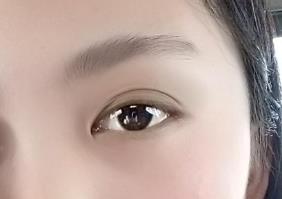 北京301醫(yī)院整形外科醫(yī)師郭伶俐簡(jiǎn)介與獨(dú)特隆鼻案例分享