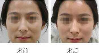 廣州脂肪隆胸領(lǐng)域的專家前五名揭曉，技術(shù)嫻熟出色醫(yī)生包括王世虎、李高峰、郝永生等