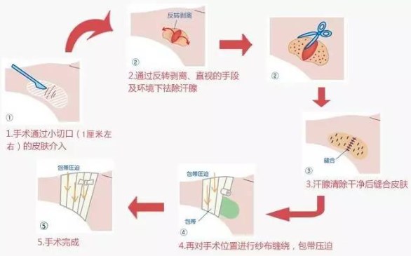 中山三院雙眼皮手術(shù)效果對(duì)比，三位專家解析詳細(xì)項(xiàng)目信息及價(jià)格表
