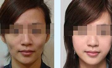 廣州擅長脂肪填充的醫(yī)生推薦：比較曾繁茂、萬友望、李宗磊等5位專家實力