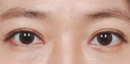 搶手的整形專家趙月強(qiáng)醫(yī)生如何評價(jià)？驚艷隆鼻案例呈現(xiàn)，聽我評！
