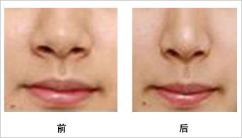 佳木斯曲學(xué)延醫(yī)生鼻子整形成果盤點(diǎn)，潮流奉上隆鼻案例魅力展示！