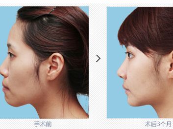 北京袁強(qiáng)醫(yī)生拉皮，醫(yī)術(shù)高超，口碑廣泛推崇