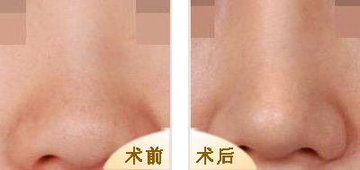 哪家醫(yī)院做雙眼皮技術(shù)出眾？費(fèi)用清單+醫(yī)生大揭秘，隨意挑選！