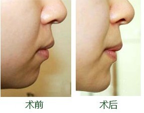 武漢中南醫(yī)院整形科最新醫(yī)師資料+整形手術(shù)價格一覽+隆鼻整形成功案例分享！