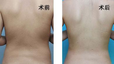 李琳做鼻子的費(fèi)用和效果如何？廣州美侖隆鼻專(zhuān)家醫(yī)生推薦！