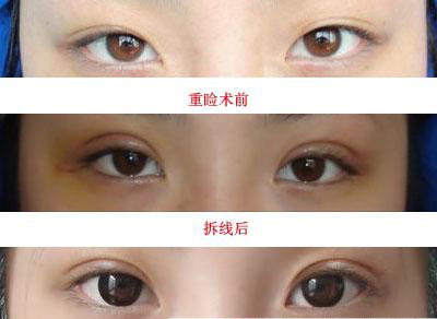 鹽城割雙眼皮首選大師王武坤，絕佳口碑強烈推薦