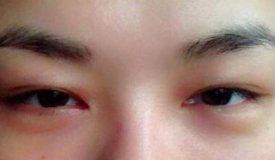 郭耐強(qiáng)鼻子整形效果詳解！回顧整個(gè)30秒恢復(fù)過程【隆鼻案例】