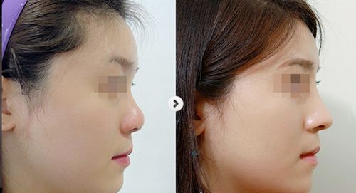 濟南哪家醫(yī)生割雙眼皮技術靠譜？趙峰、逄寶峰等對比一下