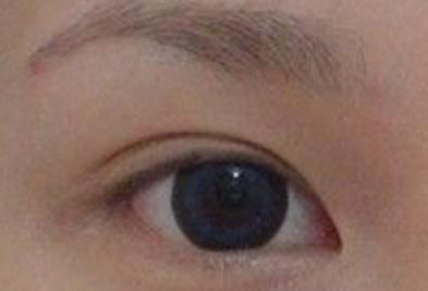 廣州曙光醫(yī)學美容醫(yī)院劉寧酒糟鼻整形的好處和效果體驗如何