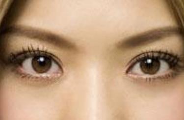 四川大學(xué)華西醫(yī)院眼袋手術(shù)：選擇何種專家好？費(fèi)用如何？
