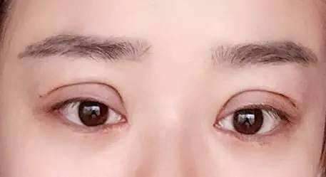 徐文龍鼻子的整形效果如何？伯思立鼻整形專家技術(shù)點評及價格！