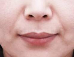 廣州曙光醫(yī)學(xué)美容醫(yī)院的蔣晟微創(chuàng)豐胸術(shù)的效果如何評(píng)價(jià)？