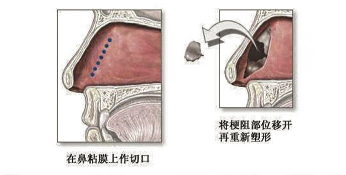上海知名整形醫(yī)生李昕的隆鼻手術(shù)經(jīng)驗(yàn)揭秘