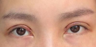 深圳藝星整形：雙眼皮效果如何？推薦優(yōu)秀醫(yī)生常德成、謝文文簡介與價(jià)格明細(xì)