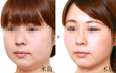 上海九院經(jīng)驗(yàn)豐富的脂肪填充醫(yī)生推薦！精選專家名單！