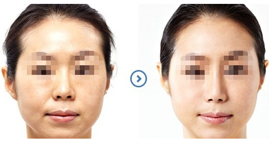 北京同仁醫(yī)院眼科專家聯(lián)手李婧與何淵，革命性近視手術(shù)新選擇揭秘市場