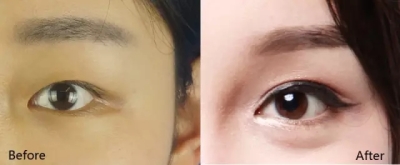 掛號(hào)指南：了解廣州華美曾高鼻子技術(shù)！獨(dú)家分享、優(yōu)質(zhì)案例