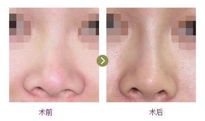 重慶美侖美奐：董開(kāi)云醫(yī)師面部提拉效果如何？費(fèi)用詳情介紹