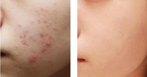 朱海杰的鼻子整形效果如何？醫(yī)生精湛技藝、多種手術風格及隆鼻知識詳解