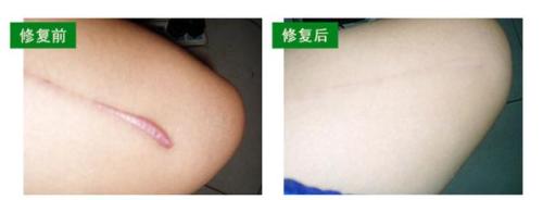 喚醒肌膚青春！聽說同濟(jì)吳敏做面部脂肪填充效果驚艷