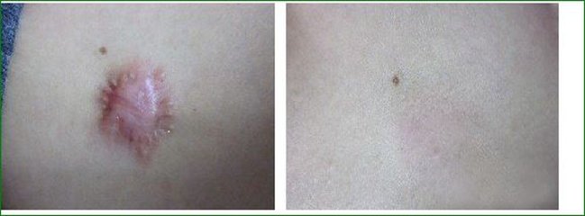上海美聯(lián)臣整形醫(yī)院安薇的韓式綜合美鼻術(shù)總結(jié)及用戶口碑評(píng)價(jià)