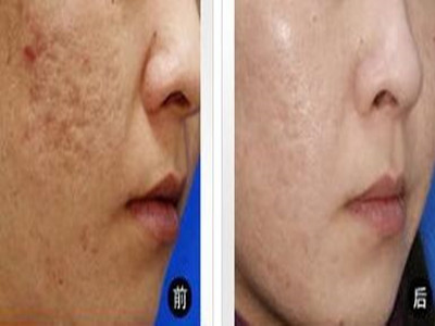 廣州比較好的拉皮手術(shù)醫(yī)生推薦！TOP5專家值得關(guān)注！詳細介紹全面資料！