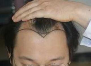 廣州整形醫(yī)生（專家）名單及價(jià)格參考，鄭廣森、齊向東等大咖測(cè)評(píng)供參考