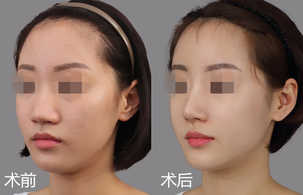 上海光博士醫(yī)療美容效果如何？醫(yī)生實(shí)力綜合評(píng)估+引人注目大腿吸脂案例分享！