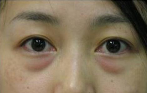 深圳尹為民醫(yī)生的從業(yè)經(jīng)歷及拉皮手術(shù)效果調(diào)查——清遠(yuǎn)市人民醫(yī)院經(jīng)驗(yàn)分享