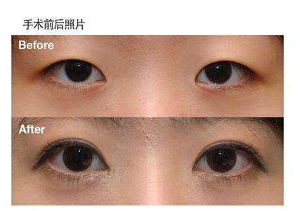 北京雙眼皮修復(fù)專家盤點，這三位專家人氣爆棚！