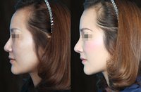 李志海醫(yī)生靠譜嗎？看看這5個(gè)月內(nèi)推顴骨案例的結(jié)果
