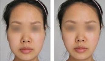 聶云飛下頜角整形經(jīng)歷：只需3個月恢復(fù)期，實現(xiàn)顏值飛升！