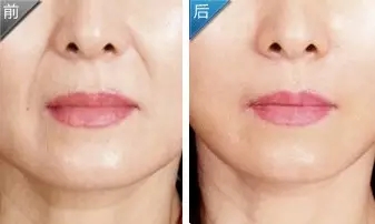廣州豐胸醫(yī)生排名及價格解析：劉志剛、楊德發(fā)等醫(yī)生實力測評！