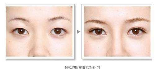 無錫美聯(lián)臣黃寅守留意隆胸？