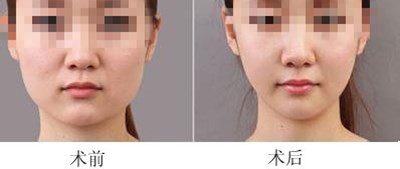 曾翾內(nèi)眼角修復(fù)術(shù)如何？上海明星整形醫(yī)生綜述，滬上醫(yī)美妙策！
