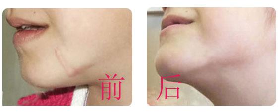 北京陳立博醫(yī)生：臉部年輕化首選！注射玻尿酸效果如何？擅長整容項(xiàng)目及價(jià)格詳解