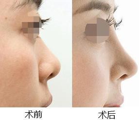 尋找北京隆鼻手術(shù)中注重自然效果的醫(yī)生，排名情況大揭秘！