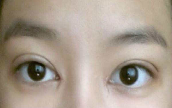 北醫(yī)三院尤維濤吸脂手術(shù)效果如何？是否長久有效？