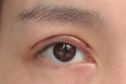 深圳美萊醫(yī)院：評(píng)測(cè)郭杰醫(yī)生的胸部整形技術(shù)，手術(shù)成果真實(shí)自然！