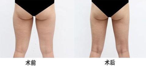 成都隆鼻手術(shù)推薦排行榜2023！卿勇、李萍、李競、鄧東偉獨(dú)家評(píng)測(cè)！