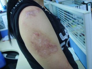 江蘇施爾美整形汪涌豐胸效果如何