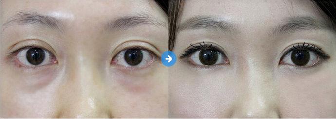 鄭州比較好的雙眼皮醫(yī)生排名公布，專家張敏、田國靜、張丹陽為您呈現(xiàn)豐富審美技術