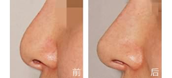 杭州隆胸專家推薦：萬連壯、盛飛、常德成等醫(yī)生評選！