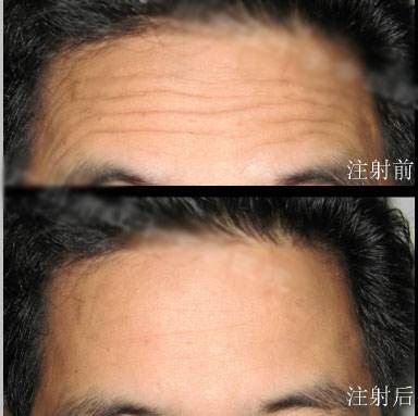 宋連城做拉皮手術(shù)的效果如何？手術(shù)案例展示、用戶評價(jià)一攬無余！